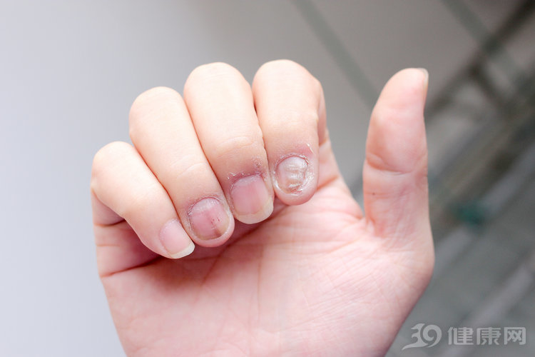 #灰指甲#为什么会得灰指甲？医生直言：如果是这5类人，得了也不奇怪！