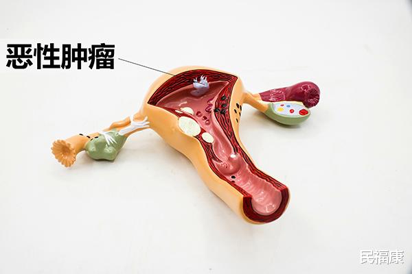 |癌症已经扩散，但患者饭量、精神、体重都很好，暗示病情好转？