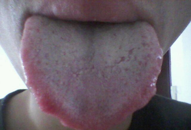 芒刺▲舌头下面的青筋为何会凸起？是身体出问题了？或是这两个问题作怪