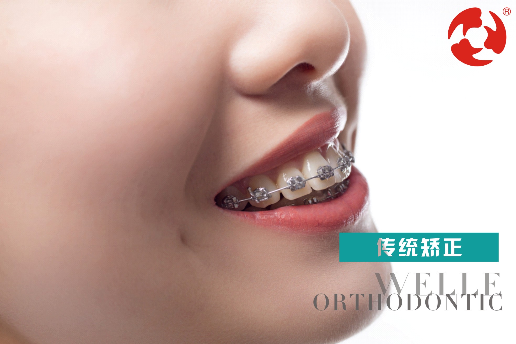 『牙齿矫正』牙齿矫正可以改变脸型？