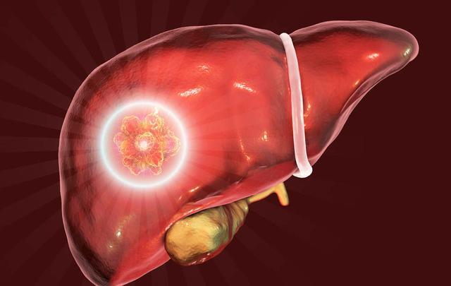 肝脏|肝内有癌，头部会出现这4种迹象！劝你早查肝CT