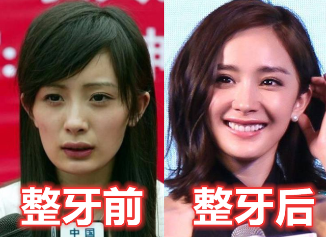 【杨幂】有种差距叫“明星整牙”，郑爽变美，杨幂气质，而她堪比“整容”