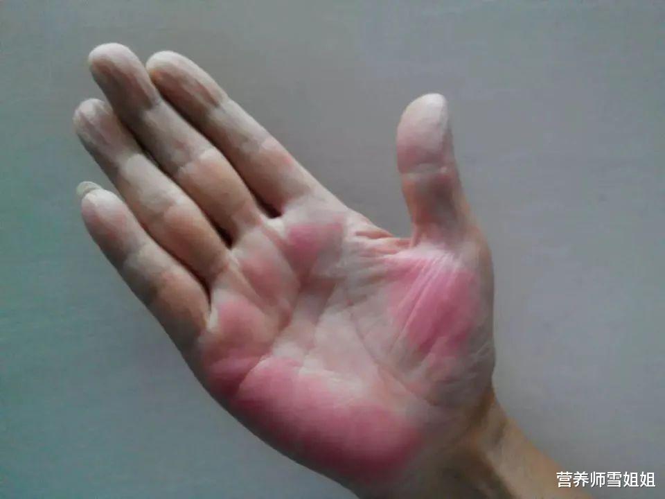 肝脏▲身体长出一痣，两处发红，半夜总自然醒，是在提醒你，肝出问题了