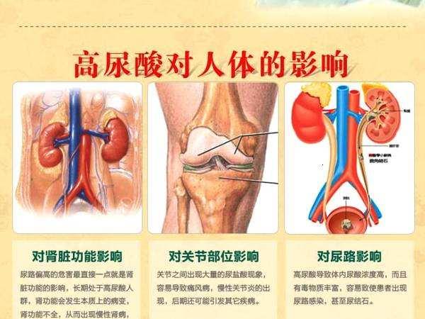 尿酸|尿酸高的人，晚上睡觉时会有异常，愿你现在还没出现三种情况