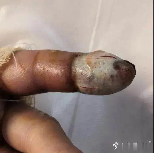 广元新闻|有人被它咬了4口后死亡！医生提醒：与它遭遇时千万别这样做…