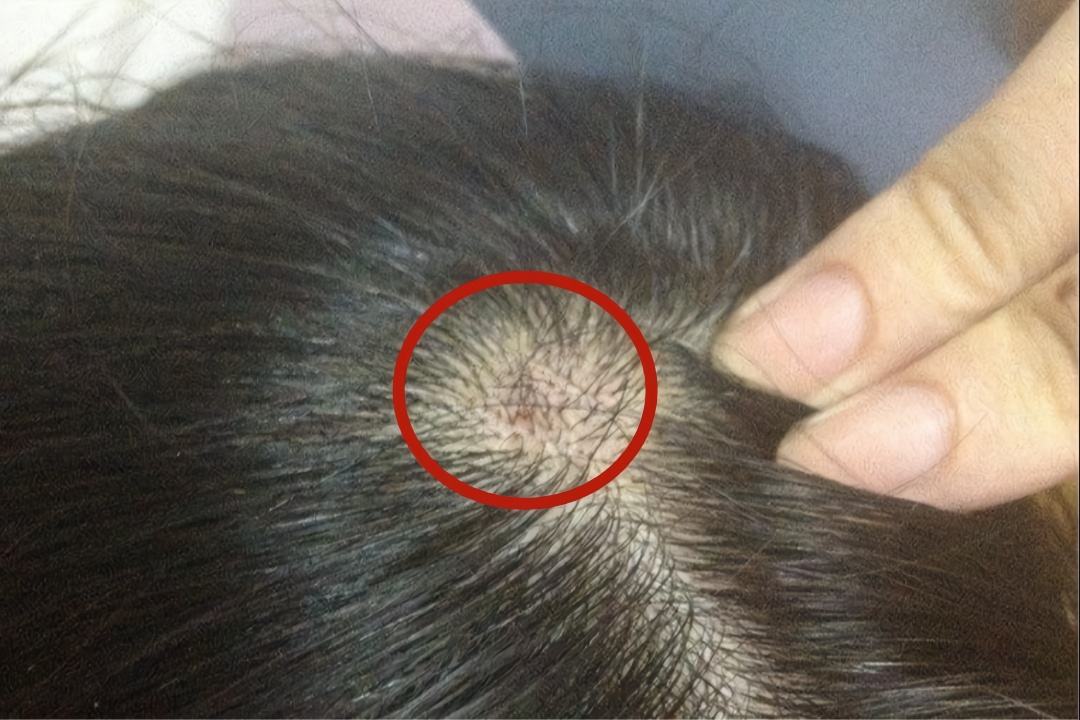 |头皮上长出的“小疙瘩”是什么？对身体有影响吗？这些常识要了解