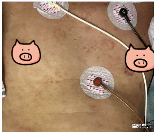 南河警方|太危险！女子景区内被咬，命悬一线！这虫广东很常见，已有多人中招