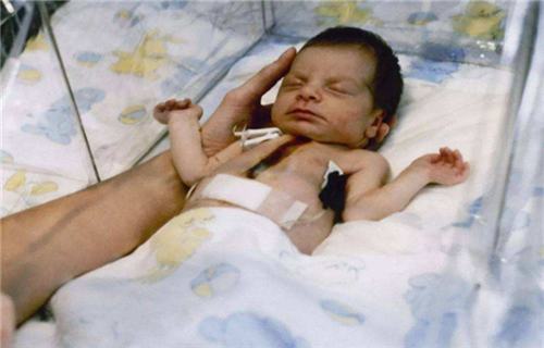 医生|36年前，美国女婴移植狒狒心脏后成功续命，最后她活了多久？