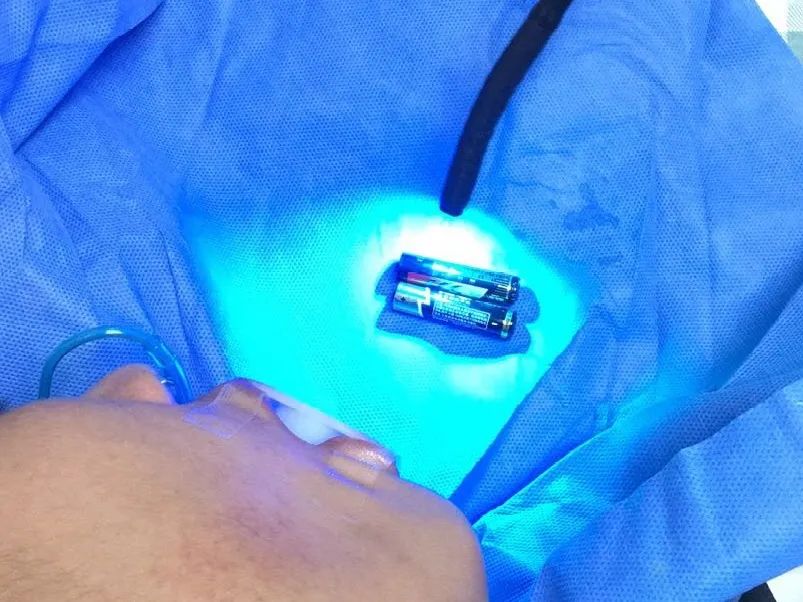 医生|【危急】东莞一小伙吞电池自杀！电池进入身体后会发生什么？