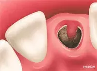 拔牙|令人闻风丧胆的"干槽症"!