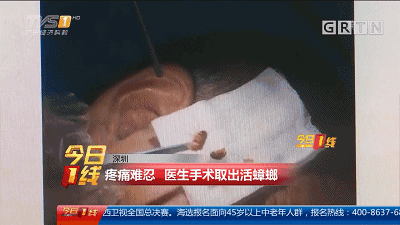 「戒烟」女子耳部不适就医，竟是这个东西躲在里面！这个季节要注意