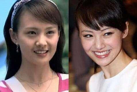 郑爽|郑爽参加《吐槽大会》整容后遗症太明显，苹果肌彻底崩塌