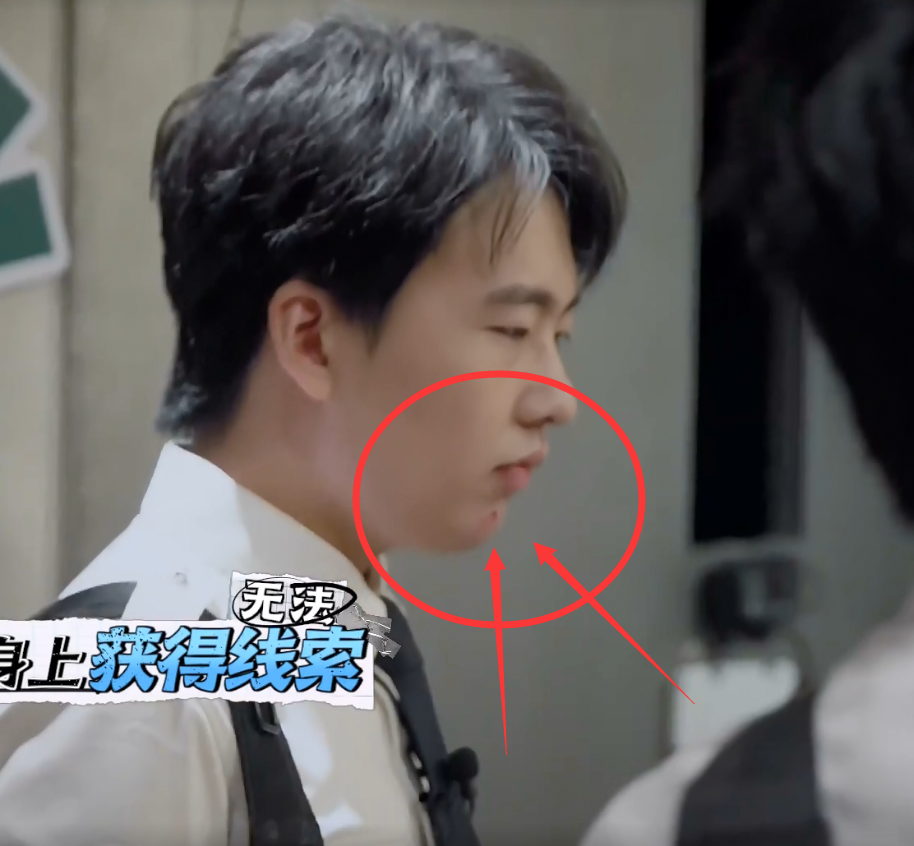 郭麒麟|《密逃》安全隐患终于暴露,郭麒麟下巴磕破,看着都疼