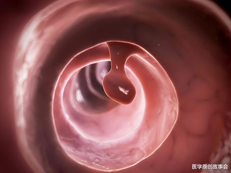 运动|这两个部位如有息肉，一定要及时切除，时间久了容易发生恶变