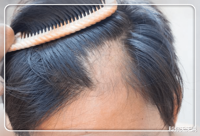 矿物油：这3种“洗发水”已被拉入黑名单，家家户户却爱用，难怪头发“大把掉”！