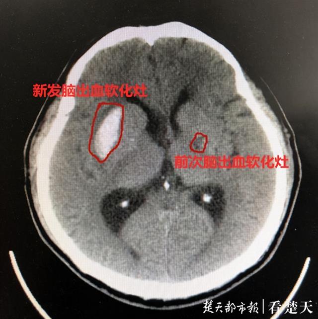 脑出血|男子半年两度脑出血，原是“激素”分泌过盛致血压失控