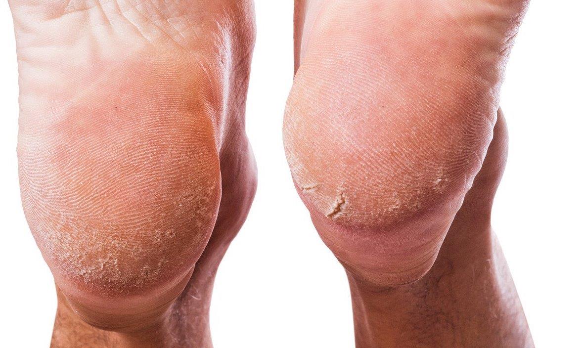 【糖尿病】四肢一旦出现这些“反常”变化，可能是血糖在报警，糖尿病快来了