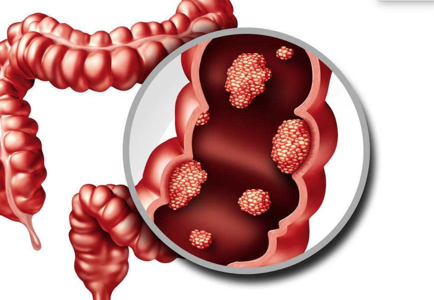 痔疮|肠道有没有息肉，去趟厕所就知道了，多做1件事，肠道越来越干净