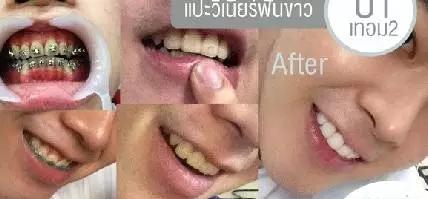 整容|泰国小哥因长太丑花74万整容，成功从丑男变网红