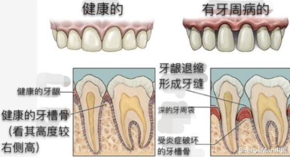 美团|十年磨一剑！无名之辈到登堂入室，这款国产冲牙器撕下智商税标签