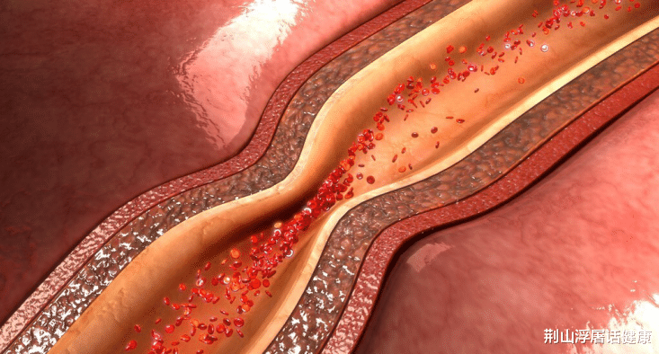 高血脂|睡觉时，出现这两种表现，说明血脂已升高，常饮1水，血管通畅