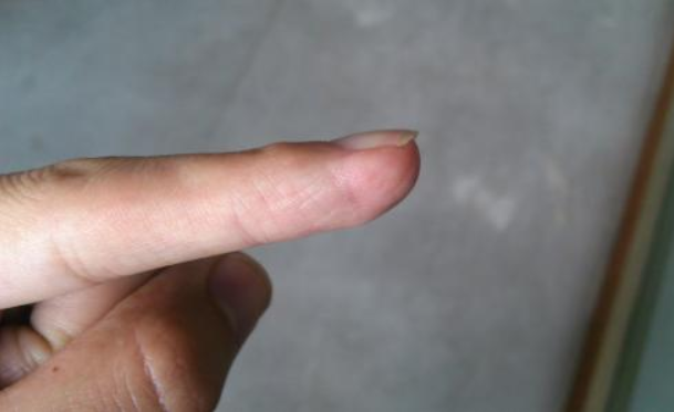 疾病|肺不好，手先知，若你手上没有4个异常，恭喜你，肺还不错！