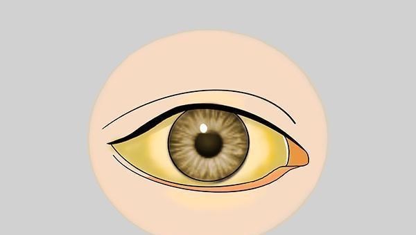 肝癌|56岁男子查出肝癌，医生惋惜：1年前就有征兆，可惜被他忽视了