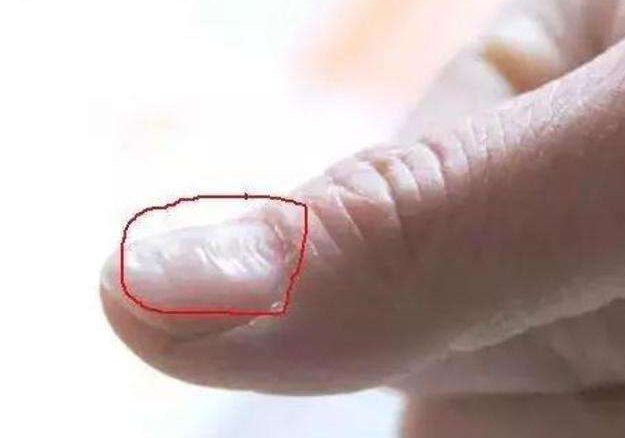 『营养膳食』肝癌“一触即发”？身体会发出“3黑”，别不当回事