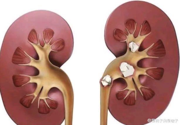 【广东省】广东一男子体内取出1258颗结石,罪魁祸首竟是它!