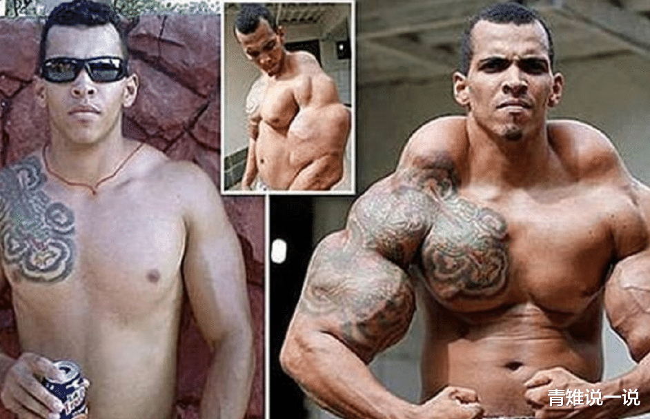 『健身』当初为了增加肌肉,拼命往肌肉注入燃油的男子,3年过后变成这样