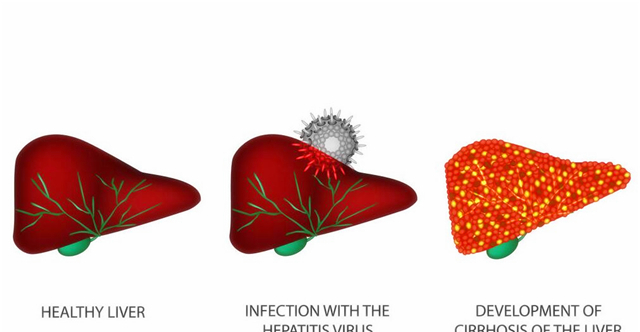 「肝脏」肝硬化的时候，肝脏发生了什么变化？你真的知道吗？看专家的理解