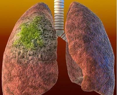 肺癌@男人这个地方越脏, 证明身体越不健康, 寿命就越短! 要警惕了