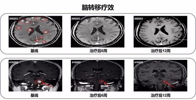 「宫颈癌」阿美替尼是否比奥希替尼更强？