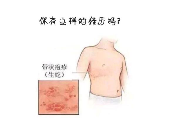 『痘痘』火龙缠腰，缠一圈会出人命？这句话可靠吗？医生对此说出了实话！