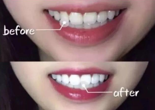 口臭：刷牙前，牙膏要不要“沾水”？听专家分析完，难怪一嘴黄牙口臭