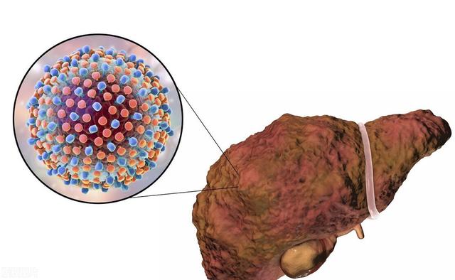 肝脏|42岁男子腹痛入院，却查出肝癌，医生摇头：这1食物吃得太勤了