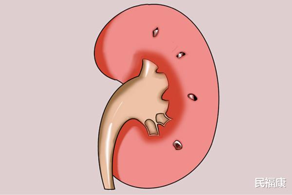 高血压|肾内科医生忠告:尿毒症患者,4种食物尽量少吃,否则肾扛不住