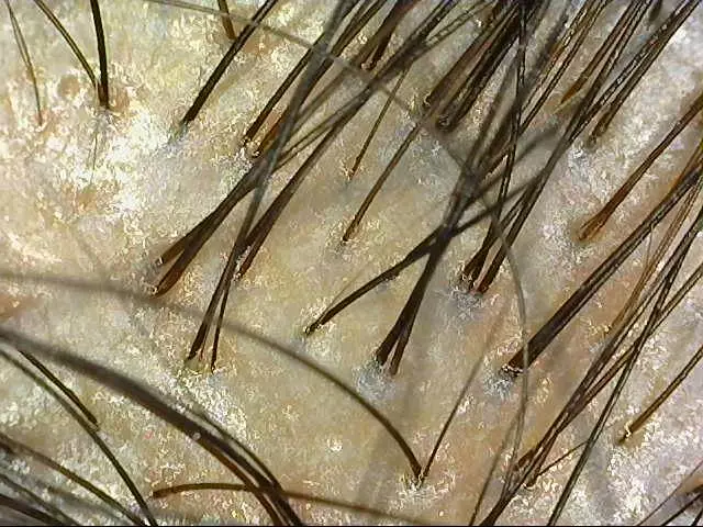 脱发|头发爱出油怎么办，还伴有掉发真是心累！