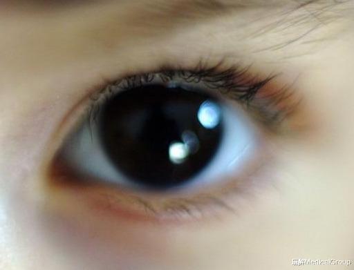 【黄芪】眼睛视力模糊究竟是怎么回事？