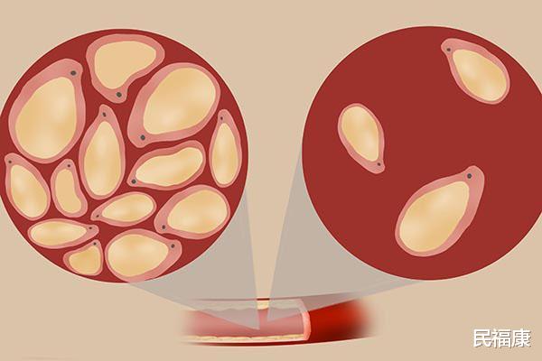 ##血液黏稠如粥，身体会发出哪些求救信号？别等血管堵塞才发现