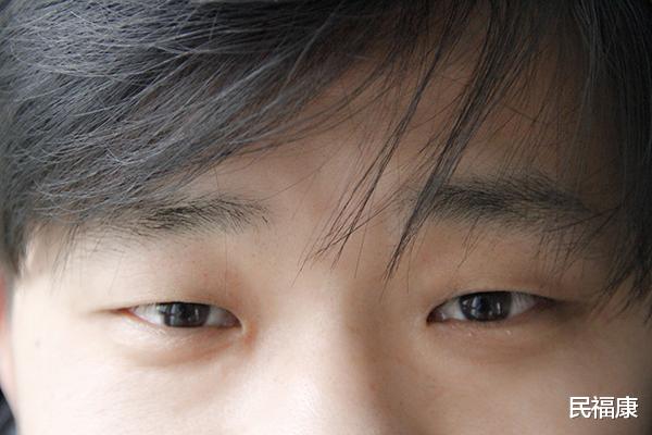 肝癌|假如一个人得了肝癌，身上会有“2黑”，45岁后无论男女都得注意