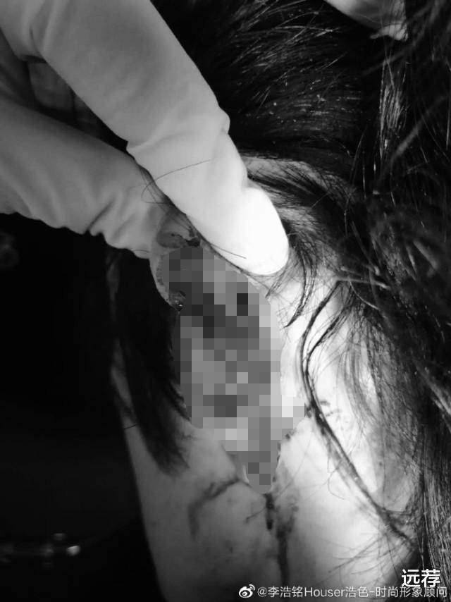 远荐|上海小伙见义勇为救被侵害女孩！耳朵被当场咬掉鲜血直流！