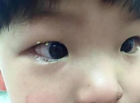 「医生」5岁宝宝眼睛突然“看不见了”,家人以为是上火,检查后医生:来晚了