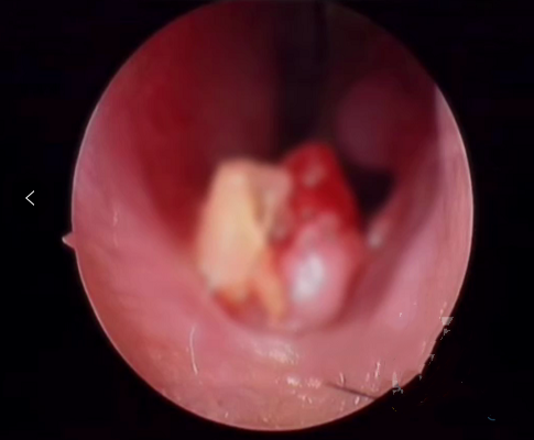 西安■6岁女童鼻子里“长牙”，取出后发现竟是三年前失踪的...