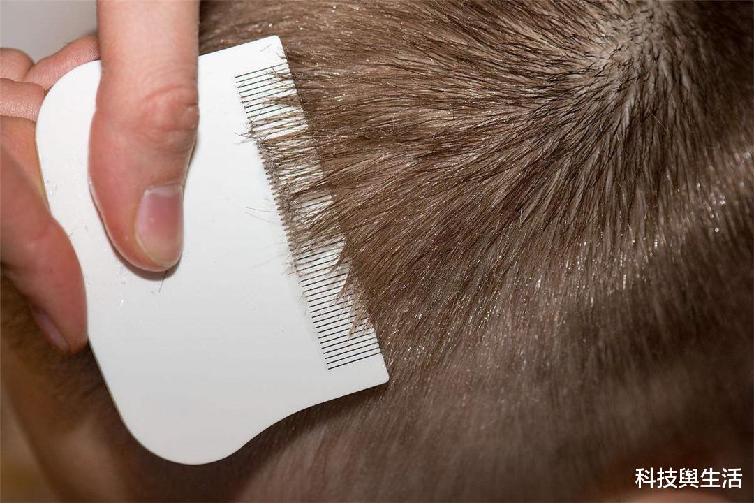 |过去困扰农村人的虱子，为何现在消失了？这个原因是关键！