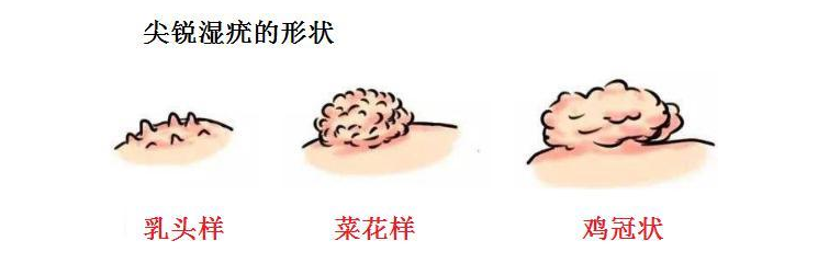 |得了尖锐湿疣，真的就治不好了吗？