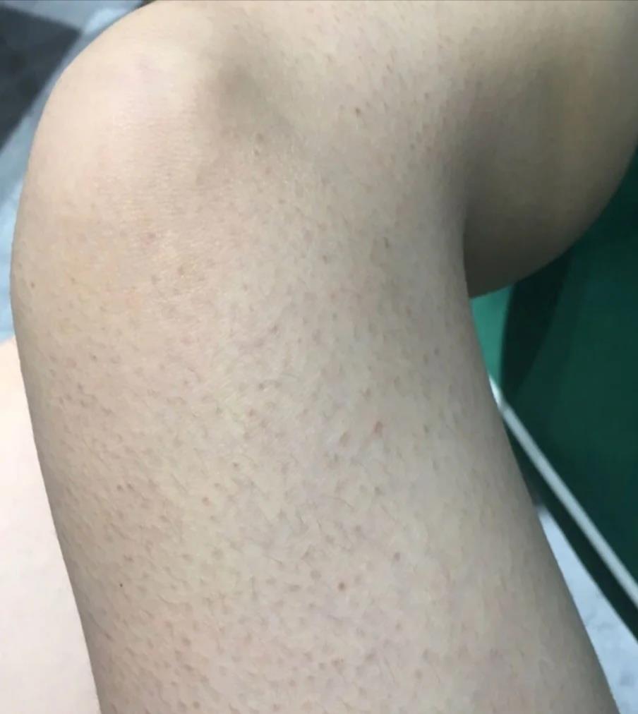 「黑头」最难解决的皮肤问题不是黑头痘痘,而是这些!8成女生都有!