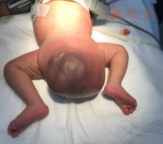 半岛晨报|女婴出生自带“炸弹”并疯狂生长