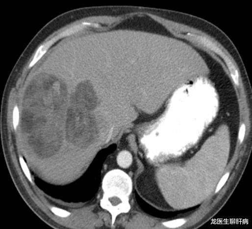肝癌|如果肝硬化变肝癌了，身体会发出什么“信号”吗？听听医生怎么说