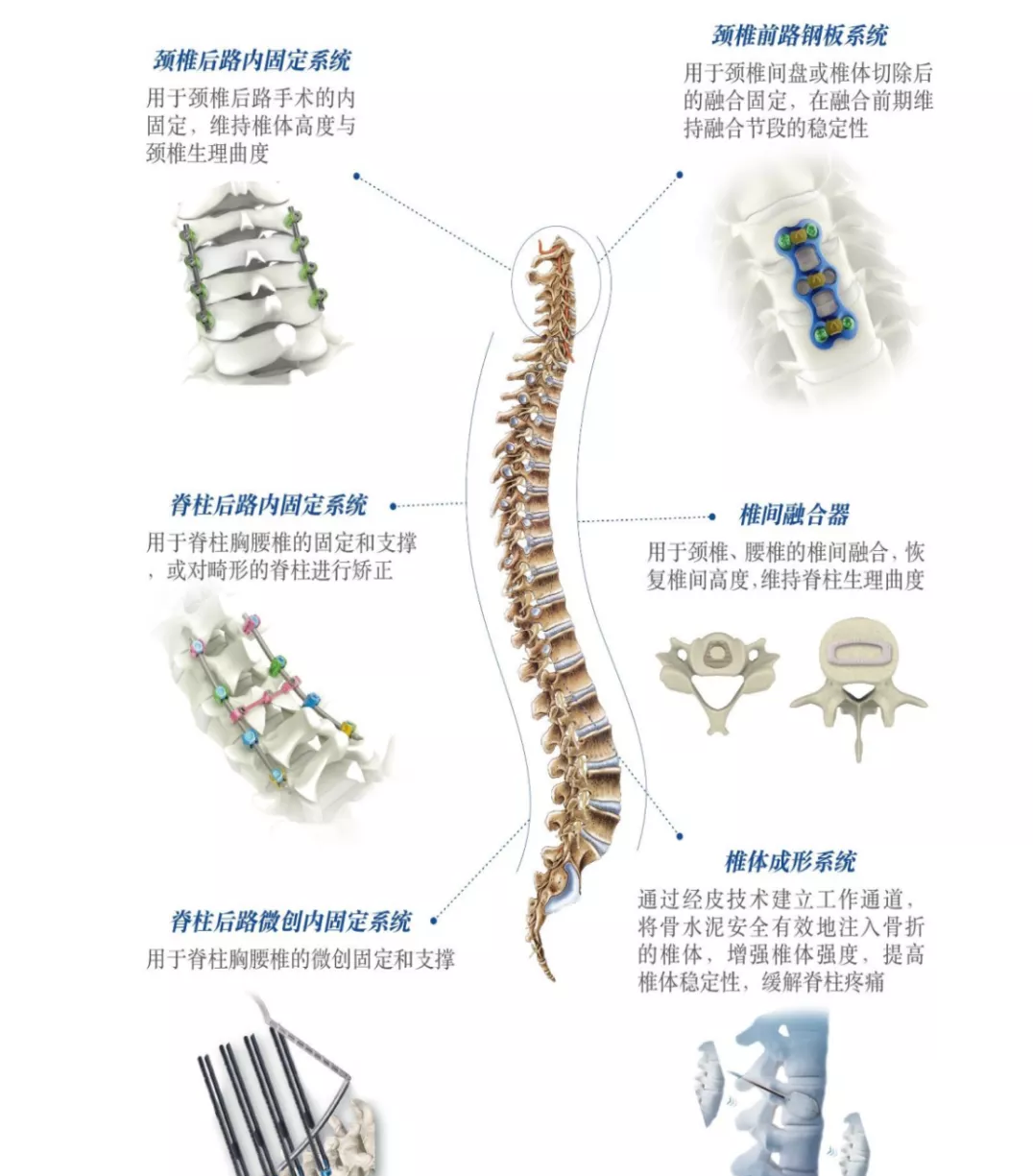 医疗器械|中国股市：骨科黄金赛道的国产第一大龙头（建议收藏）